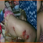 পাবনায় কুকুরের কামড়ে নারী ও শিশুসহ আহত ১১