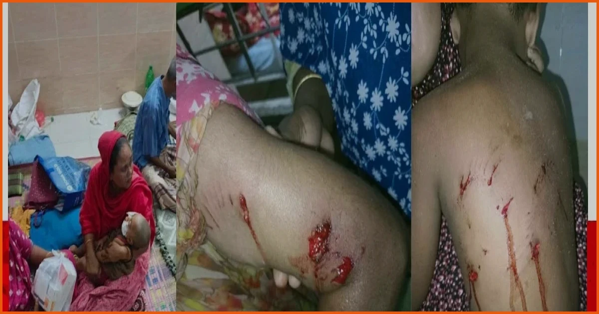 পাবনায় কুকুরের কামড়ে নারী ও শিশুসহ আহত ১১