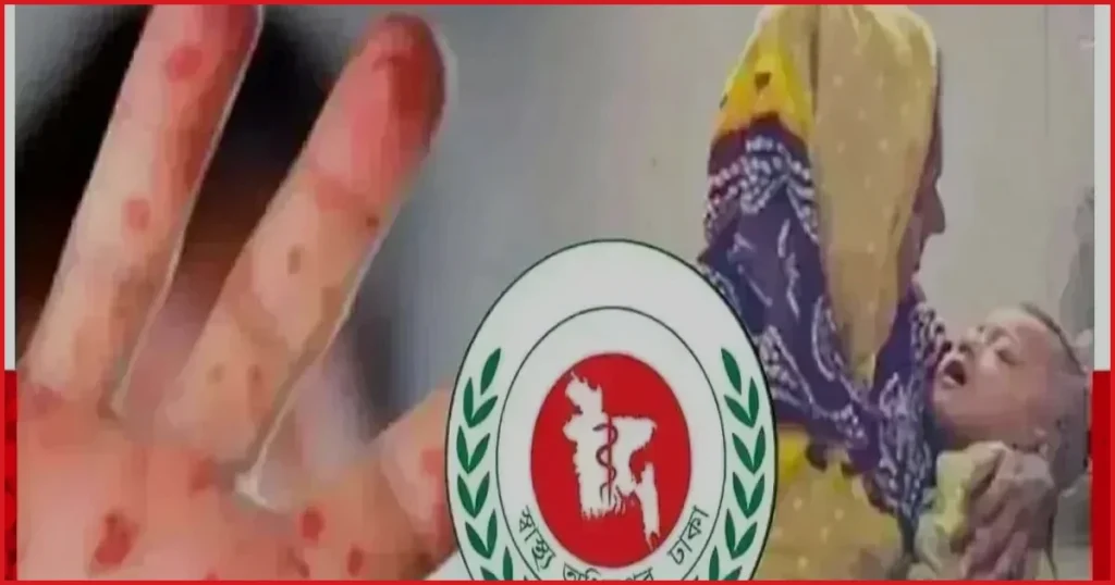 হাম ও উপসর্গে ২৪ ঘণ্টায় আরও ৮ শিশুর মৃত্যু