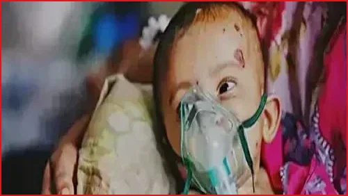 হামের উপসর্গে আরও তিন শিশুর মৃত্যু, আক্রান্ত ১২১ জন